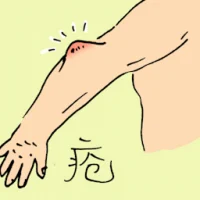 Ulcer (0878) illustration
