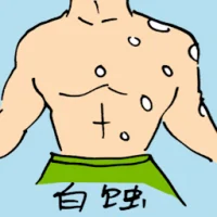 Vitiligo Skin Disease (0895) illustration