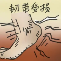 Ligament Injury (2921) illustration