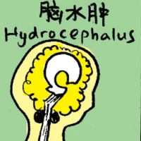 Hydrocephalus (6996) illustration