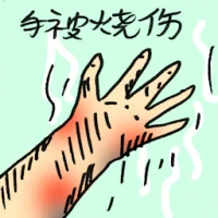 Burns On Hand (9458) illustration